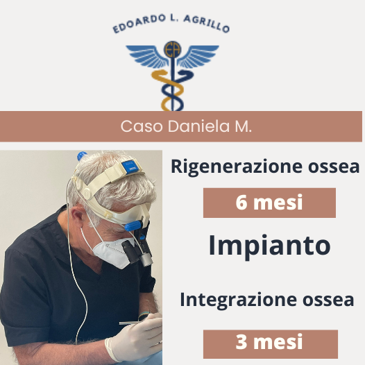 Rigenerazione e integrazione ossea impianto Agrillo