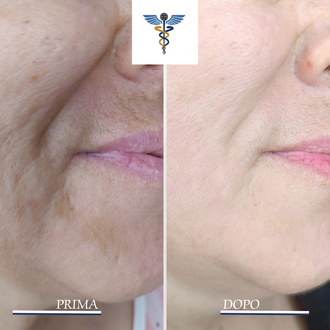 ringiovanimento viso con termolifting