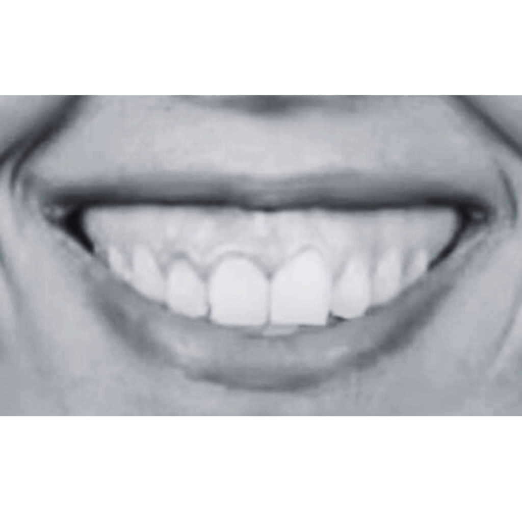 immagine di sorriso gengivale prima del trattamento